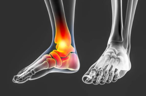 What Is Triple Arthrodesis Of The Foot And How Can It Benefit You