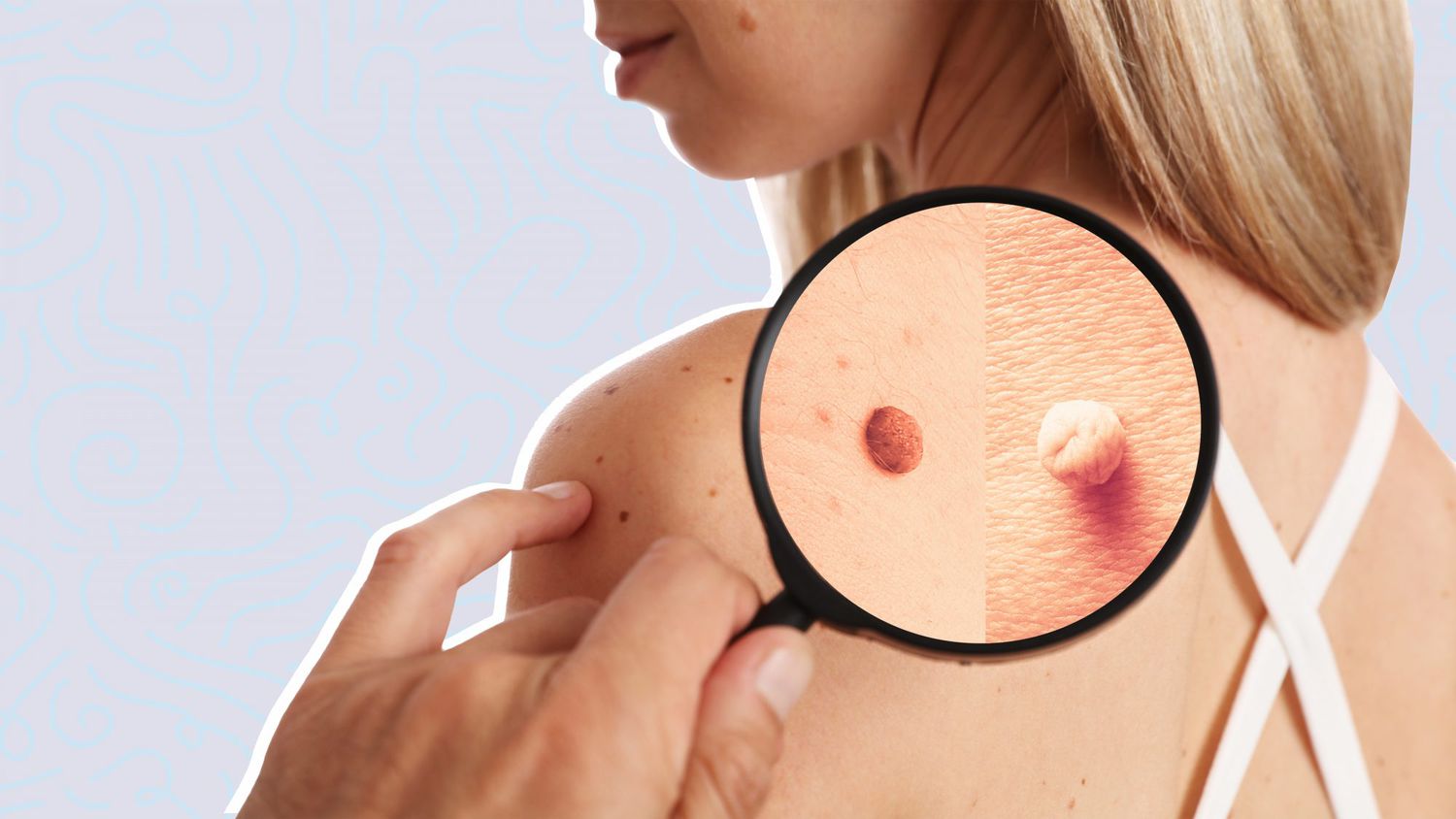 Understanding Skin Tags: Causes, Symptoms, Treatment Options, and How to Prevent Them